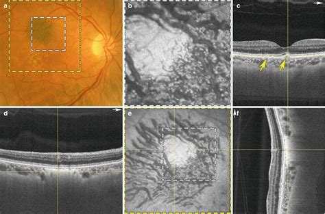 Swept Source OCT Angiography in Different Diseases | Ento Key