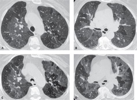 31 Bronchiolitis Obliterans | Radiology Key