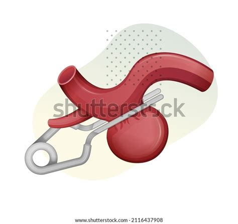 44 Aneurysm Clip Images, Stock Photos & Vectors | Shutterstock