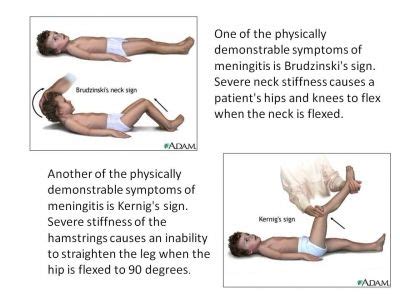 بورد 2011 pediatric - صيدلي المستقبل | Kernig sign, Nursing school ...