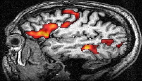 Activation in Broca and Wernicke areas for contrast "remembered >>... | Download Scientific Diagram