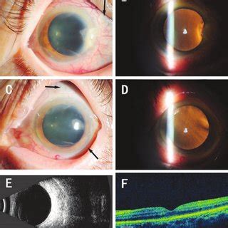 Preoperative examination results Slit lamp examination of the right eye ...