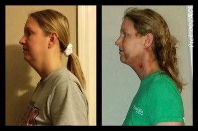 Chin Liposuction Recovery Before And After » Liposuction: Info, Prices ...