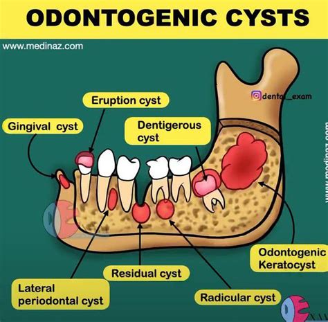 Odontogenic Cysts - MEDizzy