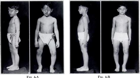 Figure 4 from LONG-TERM TREATMENT OF VITAMIN-D RESISTANT RICKETS ...