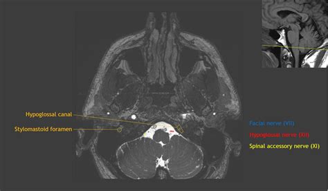 CaseStacks.com - Cranial Nerve Anatomy on MRI