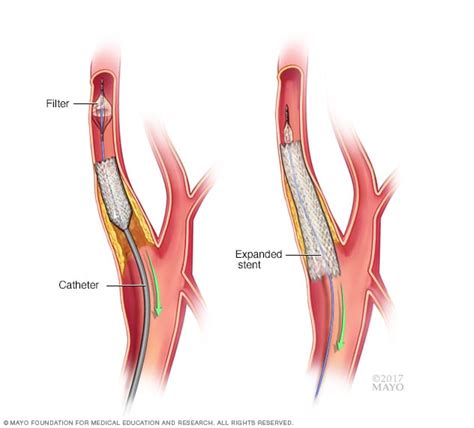 Colocación de un stent en la carótida - Mayo Clinic