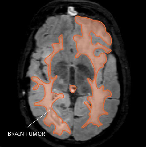 Gliomatosis Cerebri: Diagnosis and Treatment - NCI