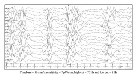 EEG findings in hypsarrhythmia (burst-suppression) variant: there are... | Download Scientific ...