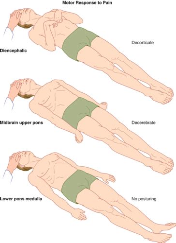 Decorticate Posturing Versus Decerebrate | Bruin Blog