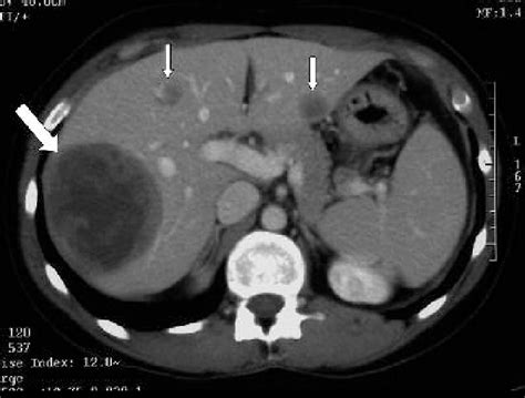 CT scan of the abdomen: 7.8-cm hypodense lesion in liver segment VII ...