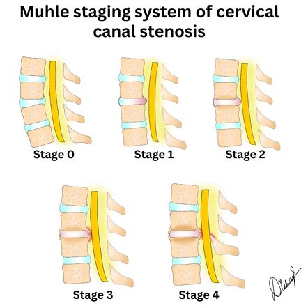 Cervical Canal