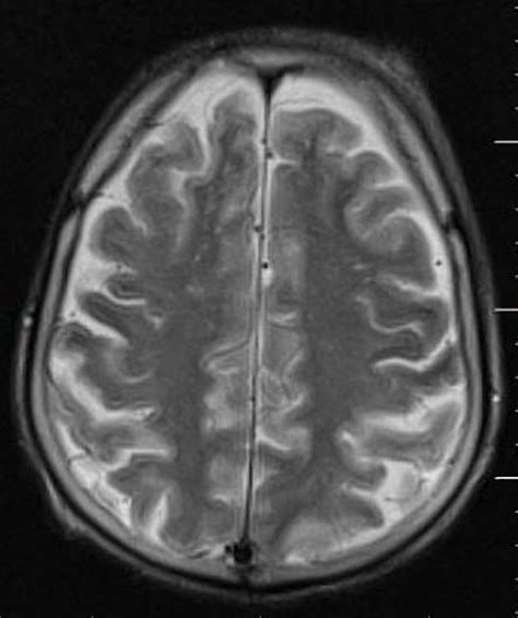 90 Amazing Can You See Anoxic Brain Injury On Mri - insectza