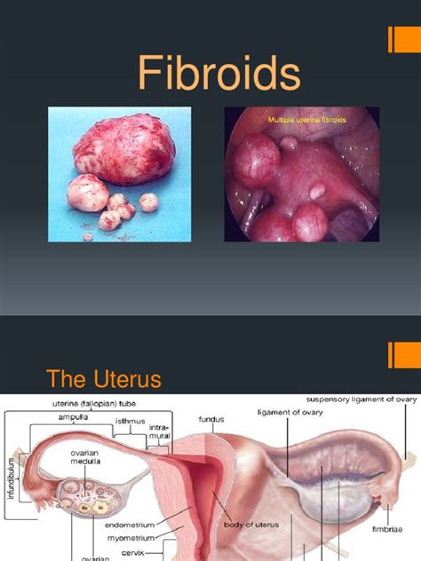 Fibroids Powerpoint | PDF | Uterus | Sexual Anatomy