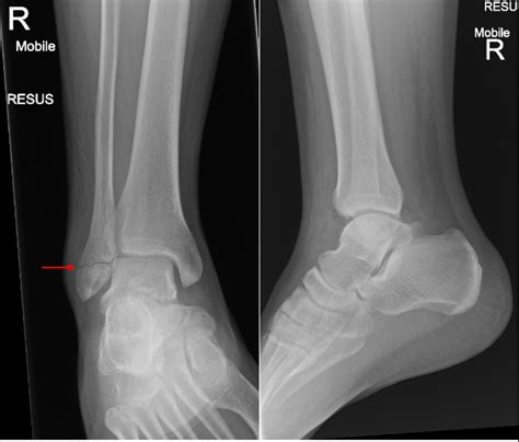 Normal Left Ankle Xray