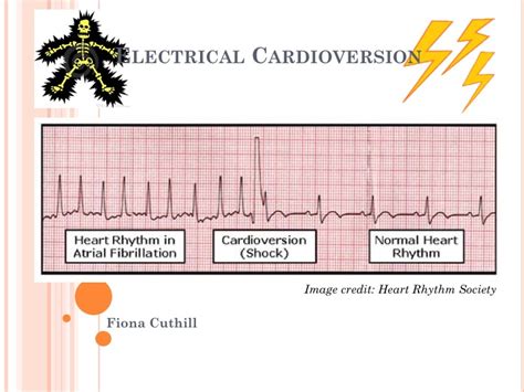 Electrical Cardioversion — learnED