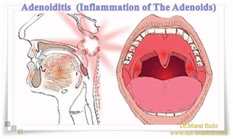 Adenoiditis - Symptoms, Causes, Diagnosis and Treatment