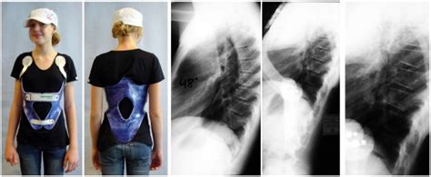 A good in-brace correction in a patient with rigid kyphosis in a ...