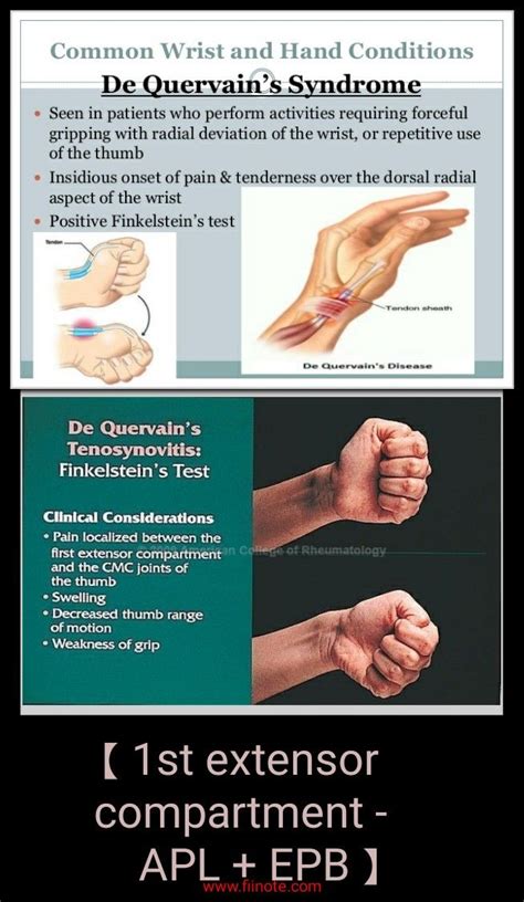 de quervain's tenosynovitis occupational therapy treatment - murray-mezquita