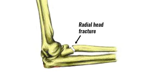 Radial Head Fracture (Elbow) - Symptoms, Causes, Treatment & Rehab