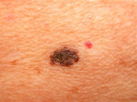 Early-Stage Melanoma Treatment Options