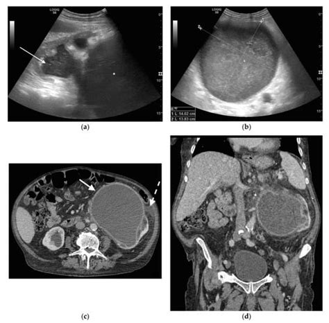 Pyonephrosis: Ultrasound and Computed Tomography | Encyclopedia MDPI