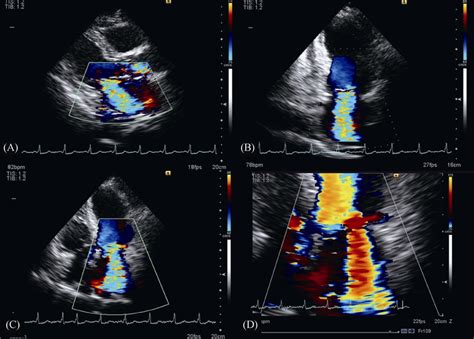 Mitral Valve Prolapse Echocardiogram | My XXX Hot Girl