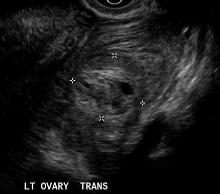 Ovary cyst burst - gaswsexy