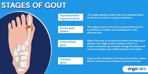 Gout Flare-ups: Rapid Treatment and Self-Care Tips