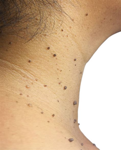 Best Skin Tag Removal Products | SoapGoddess.com