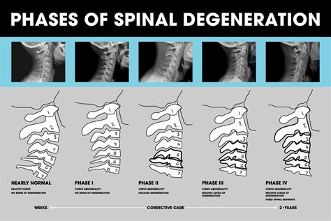 Spinal Degeneration - MIND TWEAK