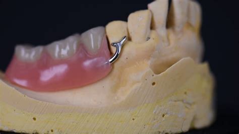 Partial Denture Clasp Types