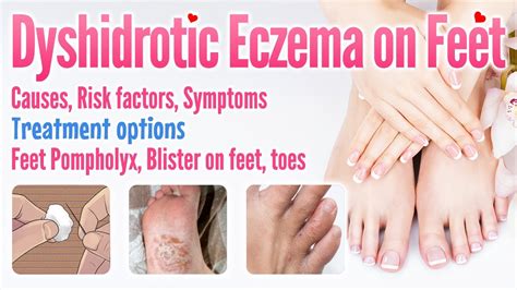 Dyshidrotic Eczema Feet - vrogue.co