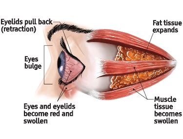 Phases of Thyroid Eye Disease