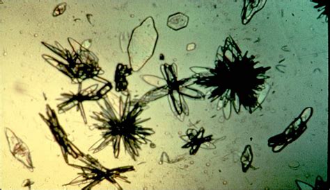 Variations of Uric acid crystals in urine | Medical Laboratories