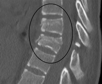 Pathological Fracture Spine