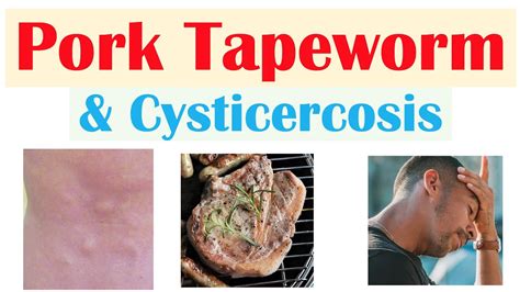 Pork Tapeworm (Taeniasis) | How It Infects, Symptoms & Cysticercosis ...