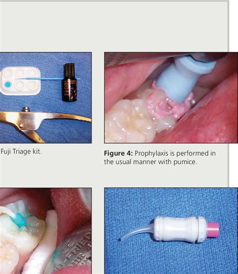 Figure 3 from The Use of Glass Ionomer Sealants on Newly Erupting Permanent Molars | Semantic ...