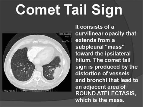 COMET TAIL SIGN - Radiology Classroom