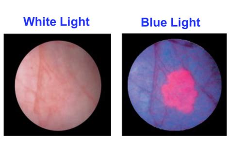 Bladder Cancer: Blue light cystoscopy - Imagin Medical