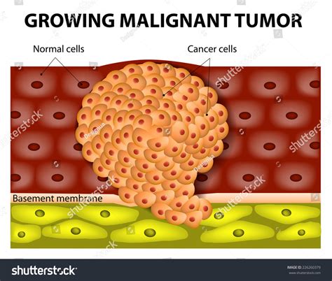 Cancer Cells Growing Malignant Tumor Malignant Stock Illustration ...