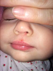 Cold Sores in Toddlers - Causes, Symptoms, Treatment & Prevention