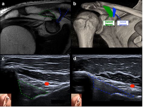 (PDF) Ultrasound of the coracoclavicular ligaments in the acute phase of an acromioclavicular ...