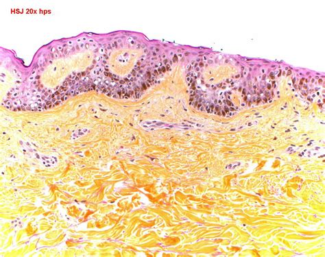 Lentigo simplex - Libre Pathology