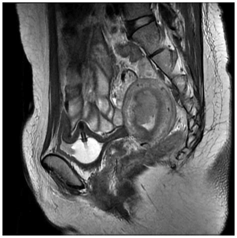 Efficacy of microwave ablation for the treatment of endometrial carcinoma: A report of 3 cases