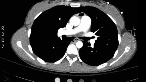 Chest Pneumomediastinum, Axial CT. JETem 2018 - YouTube