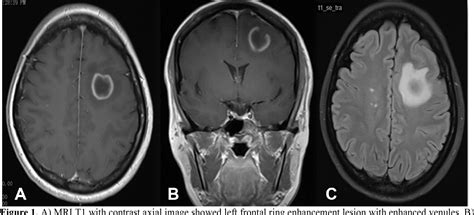 [PDF] Tumefactive multiple sclerosis masquerade as a central nervous ...