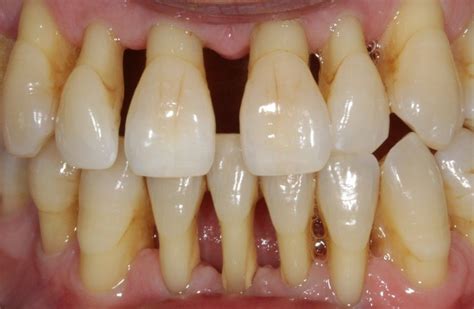 #ODC_fact Mobility is an indicator of bone loss around the tooth.Normal tooth mobility of about ...