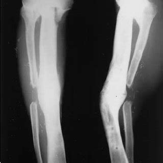 (PDF) Successful management of complications from distraction osteogenesis after osteosarcoma ...