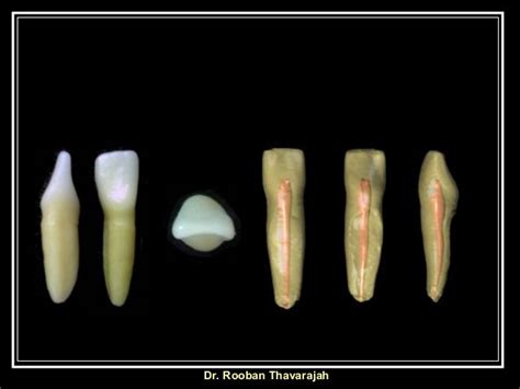 Morphology of Human Deciduous Mandibular Central Incisor Tooth